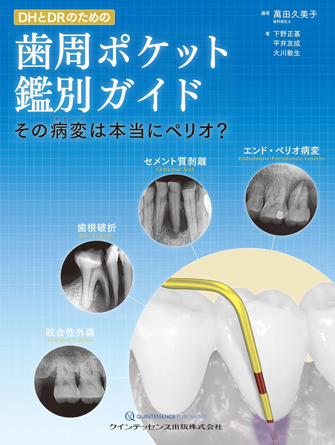 DHとDRのための⻭周ポケット鑑別ガイド その病変は本当にペリオ?