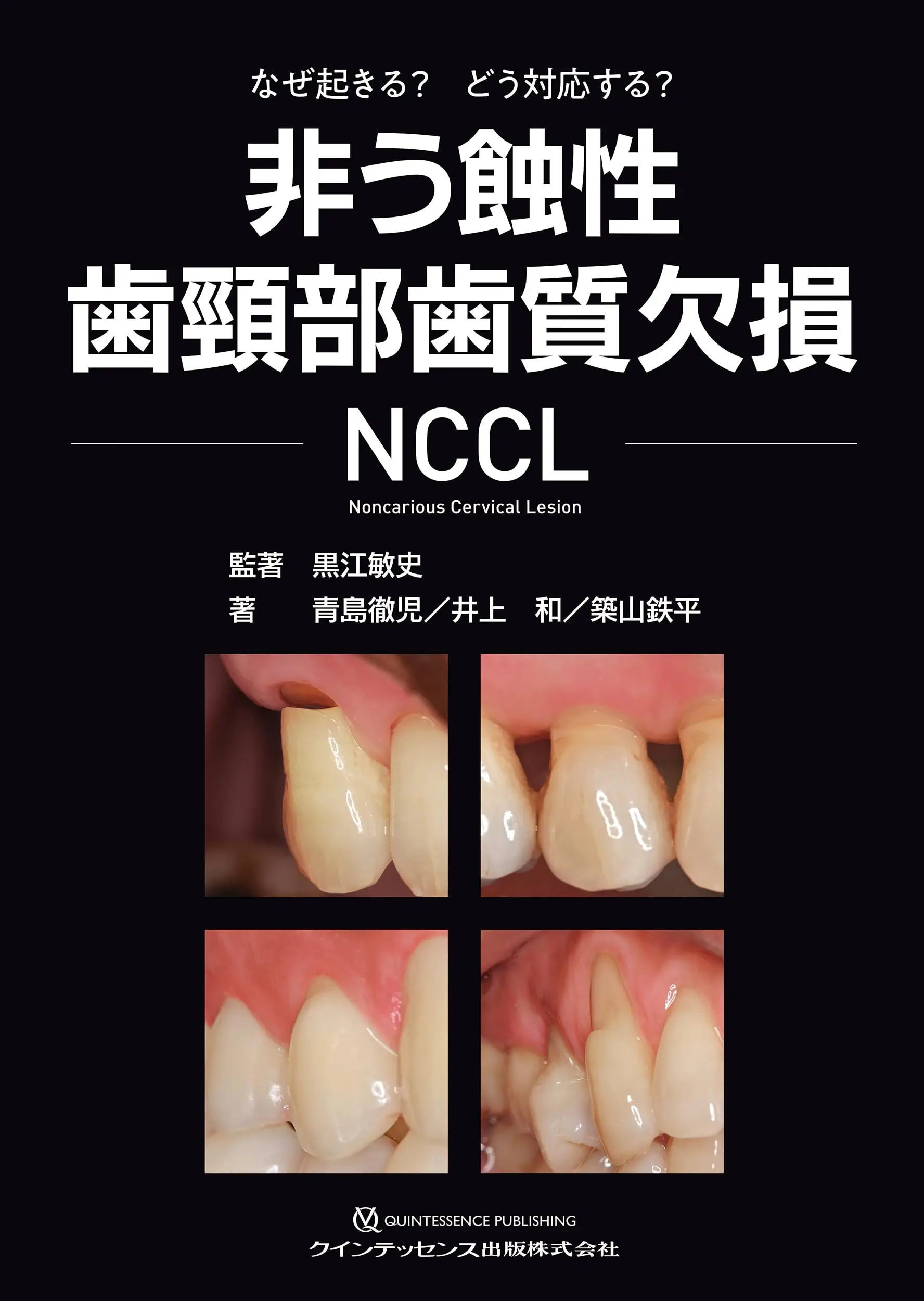 なぜ起きる?どう対応する?⾮う蝕性⻭頸部⻭質⽋損 NCCL