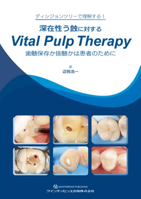 深在性う蝕に対するVital Pulp Therapy　歯髄保存か抜髄かは患者のために
